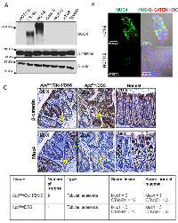 Figure 1: Increased nuclear β-catenin is associated with reduced MUC4 expression. 