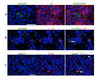 Figure  3:  ADAM17  is  expressed  by  leukocytes  in  mammary  tumors. 