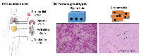 Figure 1: Common sites of incidence and pathological subtypes of pleural mesothelioma. 