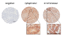 Figure 1: EGFR staining scored by localization  in patient samples. 