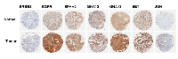 Figure 3:  IHC analysis for the expression of target proteins in the endometrial cancer TMA. 