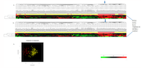 Figure 2:  Hierarchical cluster (HC) analysis of 6 candidate genes in Maire patient samples. 