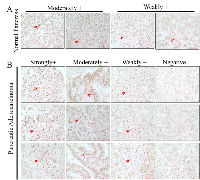 Figure 3:  Immunohistochemical analysis of mdig protein in the human pancreatic tissue and pancreatic adenocarcinoma  tissue microarray. 