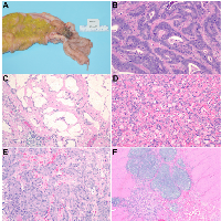 Figure 1:  Gross and Histopathologic Features. 