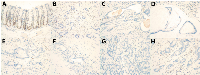 Figure 2: MLH1 Immunohistochemistry Results. 