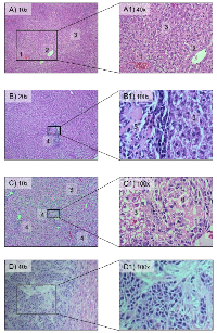 Figure 1: Histopathology of rat livers after intraportal injection of ASML PDAC cells. 