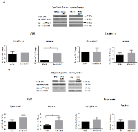 Figure 3:  Nuclear levels of ABC increases with OS progression. 