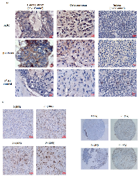 Figure 6: Immunohistochemical analysis of ABC and β-catenin in OS tissue. 