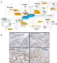 Figure 2: Differential expression and subcellular localization of BHLHE40 in various cancers. 