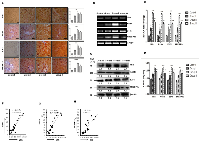 Figure 3:  Strong positive correlation between the expression of SHH and lipogenic-molecules in DEN + CCl4 induced  hepatocarcinogenesis model. 