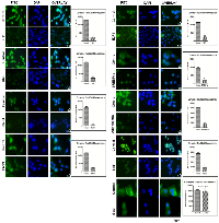 Figure 7:  Expression level of Hh and lipogenic molecules in hepatocellular carcinoma cell-line in the presence of KC. 