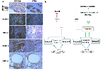 Fig. 10:  Inverse correlation between TMEPAI and PTEN expression in TNBC tumors by IHC.