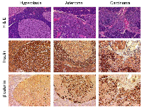 Figure 1: Tumor progression in Cdk4R/R pancreas. 