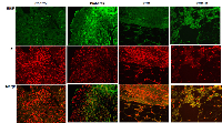 Figure 2:  Immunostaining of INSR in kidney sections from control, diabetes, RCC, and RCC+diabetes. 