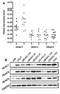 Figure 1: The expression of HDACs is upregulated in  HNSCC  patient’s  primary  tumors  and  cell  lines. 