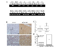 Figure 3:  Representative results of RASSF10 methylation and expression in primary HCC. 