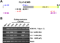 Figure 2:  Expression of FLI-1-EWS in Ewing sarcoma tumors. 