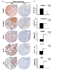 Figure 1:  Immunostaining and semiquantitative evaluation of CRBP-1 and other biomarkers in TMA sections of  lung adenocarcinomas. 