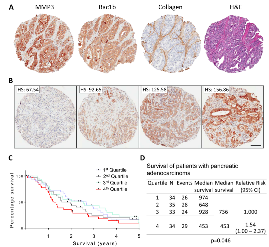 Figure 1:  MMP3 and Rac1b tissue expression in pancreatic adenocarcinoma. 