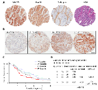 Figure 1:  MMP3 and Rac1b tissue expression in pancreatic adenocarcinoma. 