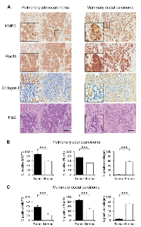 Figure 2:  MMP3 and Rac1b tissue expression in pulmonary adenocarcinoma and mammary ductal carcinoma. 
