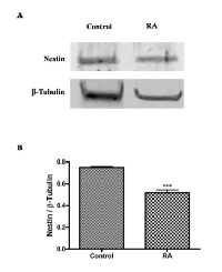 Figure 4:  Nestin expression in undifferentiated and RA  differentiated  neuroblastoma  cells. 