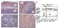 Figure 5:  Reduced UBE4B Expression Is Associated with Poorly Differentiated Tumors. 