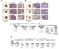 Figure 6:  UBE4B Expression in Neuroblastoma Tumor Tissue Arrays. 