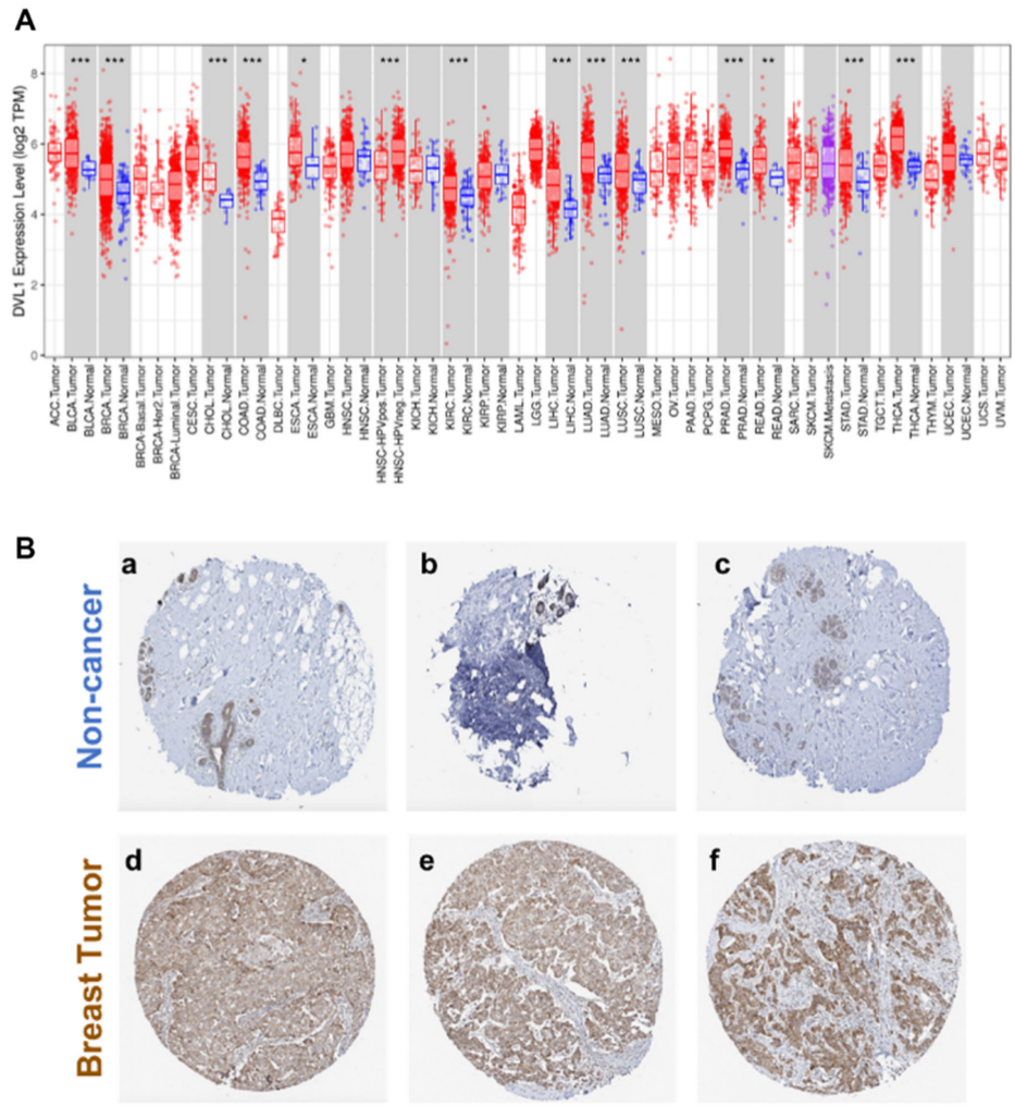 Genes & Cancer Genomic profiling of DVL1 and its nuclear role as a