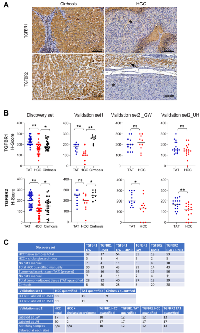 Figure 1: IHC analysis of TGFBR1 and TGFBR2 in liver tissue from cirrhotic patients with or without HCC.