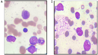 Figure 1: Note myeloblasts: Granular blast cells or with Auer bodies.