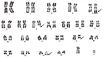 Figure 3: 46, XY, t (8, 21) (q22; q22) with t (5, 17) (q35, q21) Karyotype.